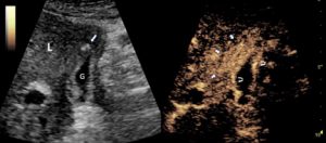 Figure 3. Axial contrast-enhanced ultrasound (CEUS) of the gallbladder at a comparable level as CT images in figure 1, taken 2 weeks after the CT, on the left without contrast and on the right with contrast: The left image is optimized to show anatomy of liver (L) and gallbladder (G), the right image is optimized to show the contrast bubbles. One gallstone had migrated from the gallbladder into the liver (arrow on left). The irregular gallbladder wall thickening demonstrates strong enhancement (curved arrows on right) and does not demonstrate any underlying mass. There is strong enhancement of microbubbles in the liver parenchyma around the gallbladder (short arrows on right), corresponding to the dark zone of tissue on the CT (figure 1 and 2), which is typical for an inflammatory reaction due to gallbladder inflammation.