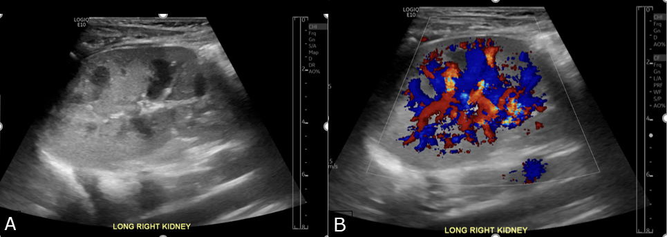 Figure 1: Longitudinal Grayscale of the Right Kidney (A), and Doppler Imaging (B) did not show any focal abnormality