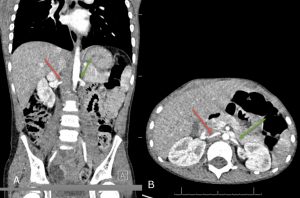 Figure 2: CTA: Select coronal (A) and axial images (B), did not show any abnormal areas of perfusion, cortical atrophy or focal abnormalities of the right renal artery (red arrow) or left renal artery (green arrow). 