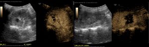 Figure 4: Transverse and longitudinal images from the contrast-enhanced ultrasound imaging showed a well demarcated region of decreased perfusion within the region of interest in the posterior aspect of the right lower pole of the right kidney. 