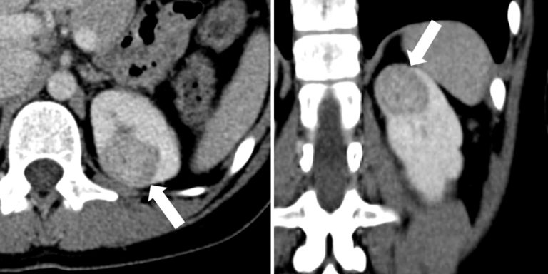 ceus-shows-kidney-mass-is-benign-after-ct-suggests-cancer