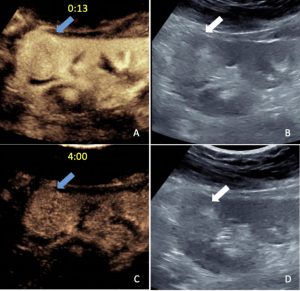 CEUS shows kidney mass is benign after CT suggests cancer ...