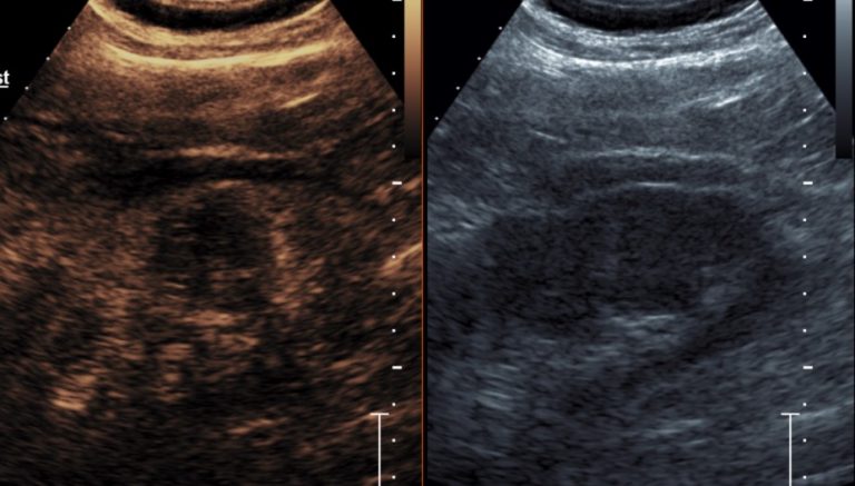 Body Imaging - Kidney - International Contrast Ultrasound Society