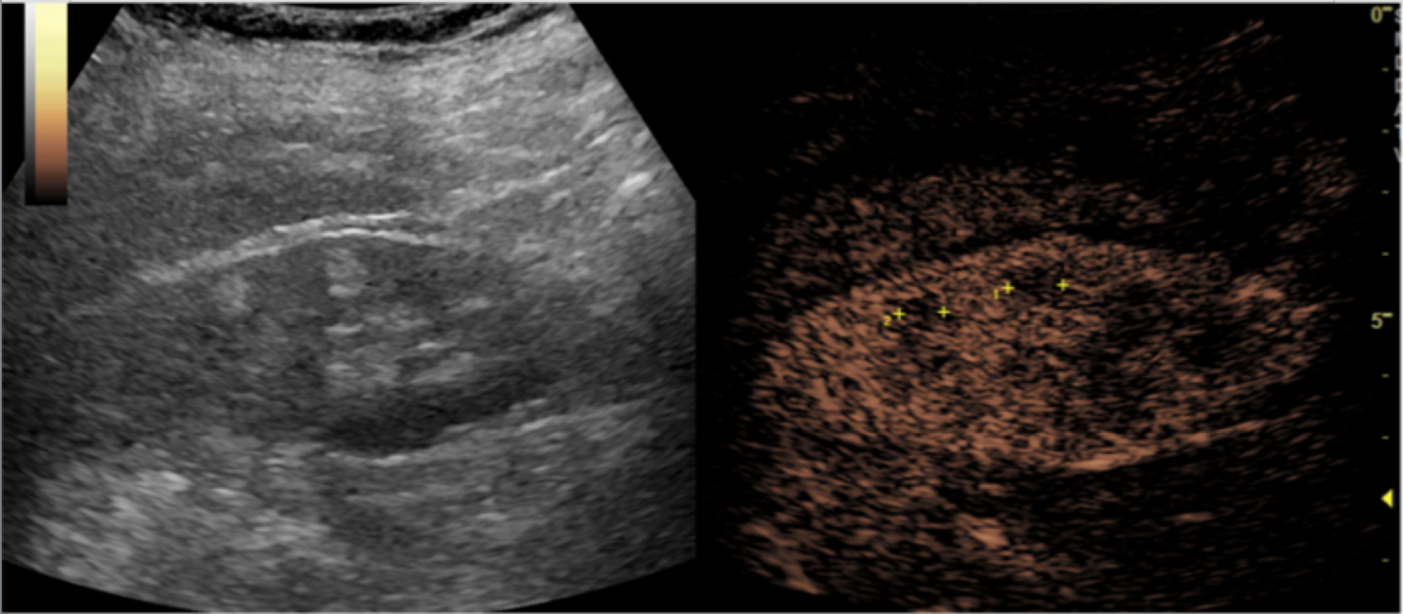 Body Imaging - Kidney - International Contrast Ultrasound Society