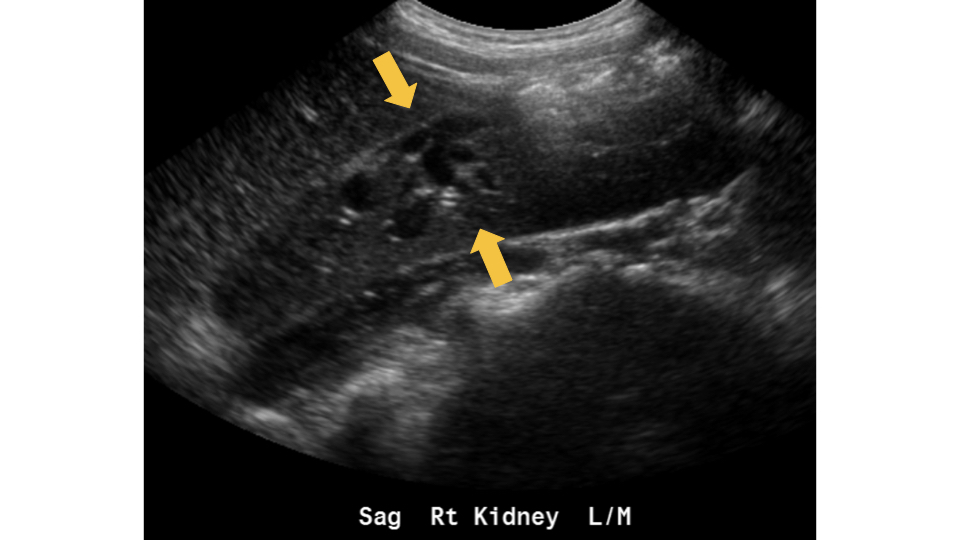 ICUS-Bubble-blog-renal-abscess.001