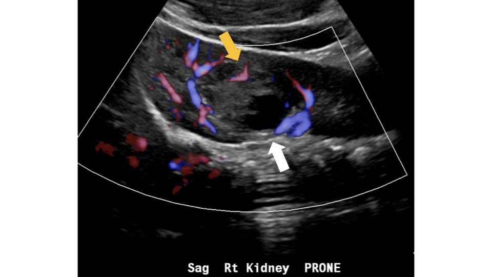 ICUS-Bubble-blog-renal-abscess.002