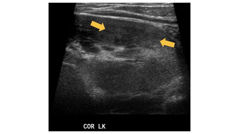 ICUS-Bubble-blog-renal-abscess.004