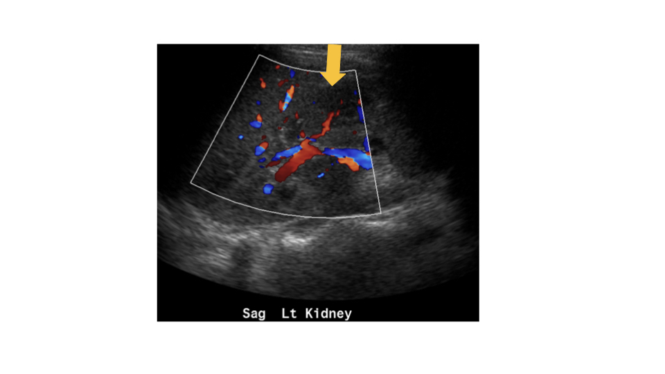 ICUS-Bubble-blog-renal-abscess.005