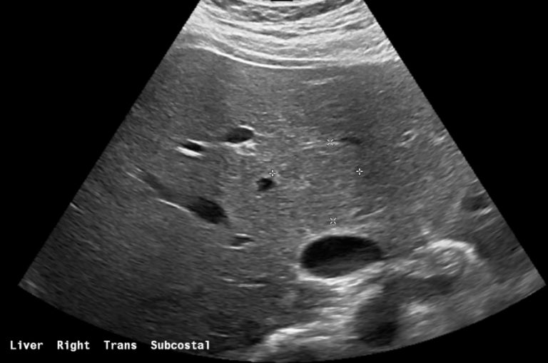 Figure 2: ultrasound of the liver demonstrates a vague mass (outlined by calipers), barely discernible from the liver background
