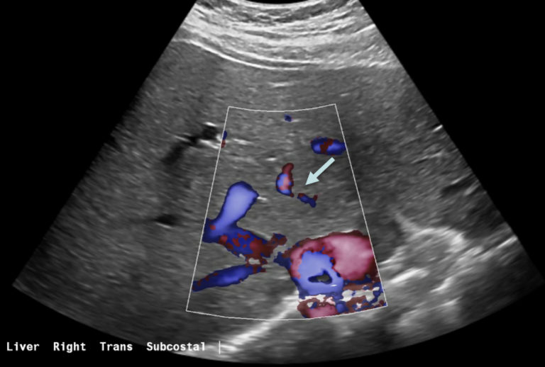 Figure 3: Ultrasound color Doppler shows two blood vessels radiating from the center of the mass, suggestive, but not definite for focal nodular hyperplasia (FNH).