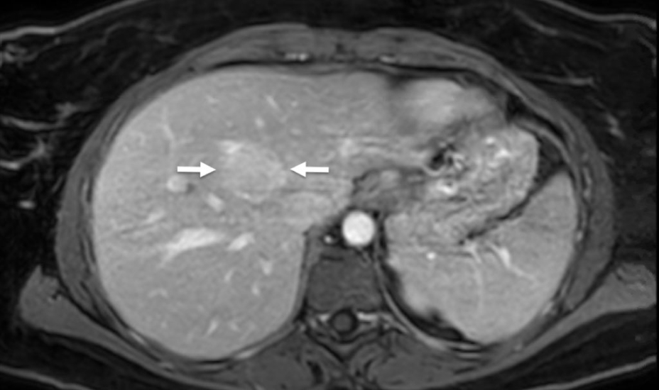 Figure 1: MRI of the liver with contrast demonstrates a round enhancing mass, which is not further characterized.