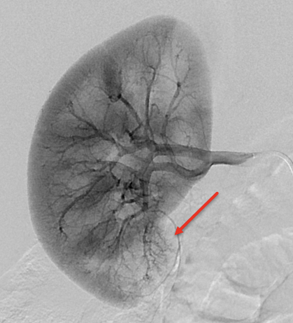 Figure 3: Select image from the right main renal angiogram showing small tortuous vessels (red arrow) in the lower pole of the right kidney with reduced perfusion.