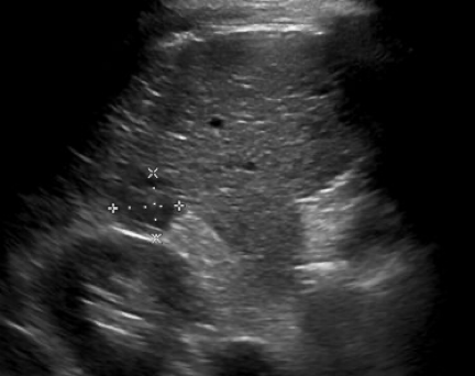 Figure 1: Biannual liver screening ultrasound demonstrated this hypoechoic mass (outlined by calipers), suspicious for hepatocellular carcinoma