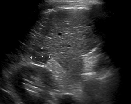 liver cancer ultrasound