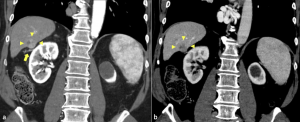 Figure 2: CT shows the same liver mass with (a) arterial hyperenhancement (arrowheads) and (b) washout in the venous phase, which are characteristics for hepatocellular carcinoma. Note blood vessel in between liver and right kidney, which is not usually seen and is of uncertain etiology (arrow).
