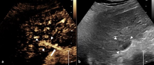 Figure 3: a) Contrast-enhanced ultrasound with avid enhancement of the mass (arrowheads) with a clear feeding artery coming from outside the liver (arrow). b) Corresponding conventional ultrasound image does not show the blood vessel.  Identifying this arterial supply assisted the medical team in exploring local treatment of the tumor.