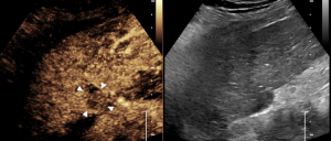 Figure 4: During the washout phase of the contrast-enhanced ultrasound, there is evidence of washout within the mass (arrowheads), which is characteristic of hepatocellular carcinoma. Additionally, there is no evidence of dilated vessels to suggest tumor in vein.